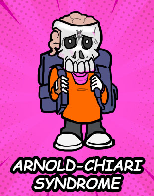 Arnols Chiart syndrome